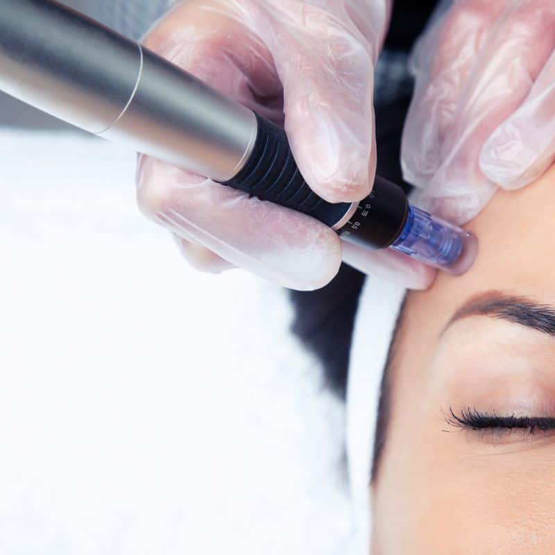 Morpheus8 treatment Peak Dale from Lipo Sculpt - Book in today!